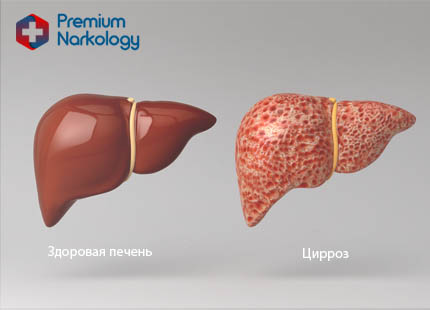 Этапы повреждения печени Рисунок здоровой и больной печени